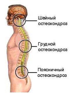Принципы диеты при остеохондрозе позвоночника