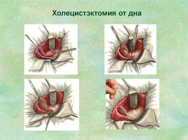 Что такое холелитиаз: симптомы и лечение
