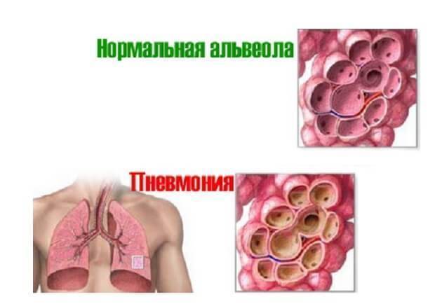 Особенности течения и лечения двухсторонней пневмонии легких