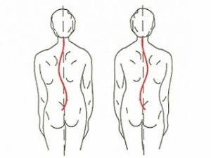Сколиоз 3 степени: причины, симптомы, лечение