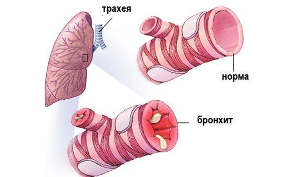 Антибиотики при бронхите у взрослых. лекарства в таблетках, уколы. название и описание