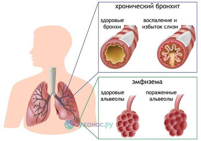 Хобл: классификация по степени тяжести, этиология, патогенез, диагностика, лечение, 2, 4, как долго можно прожить