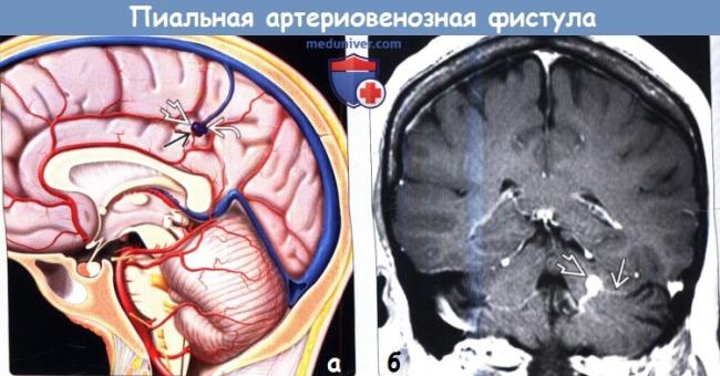 Артериовенозная фистула
