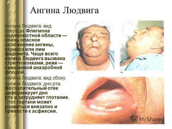 Лечение гнойной ангины народными средствами