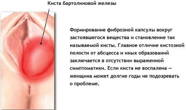 Абсцесс бартолиновой железы
