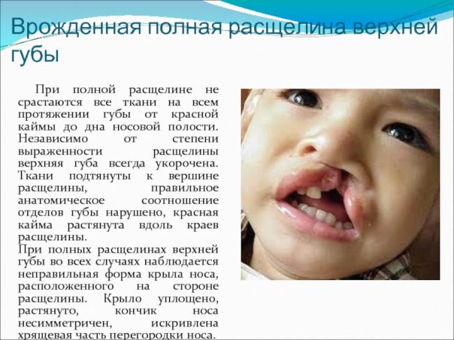 Волчья пасть. причины, симптомы, пластическая операция и реабилитация :: polismed.com