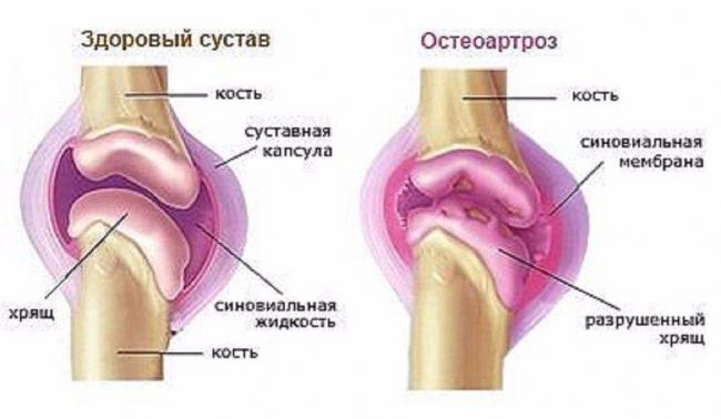 Пиаскледин 300 Piascledine 300