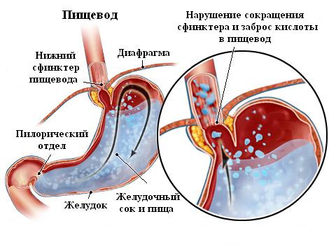 Недостаток кардии желудка лечение народными средствами