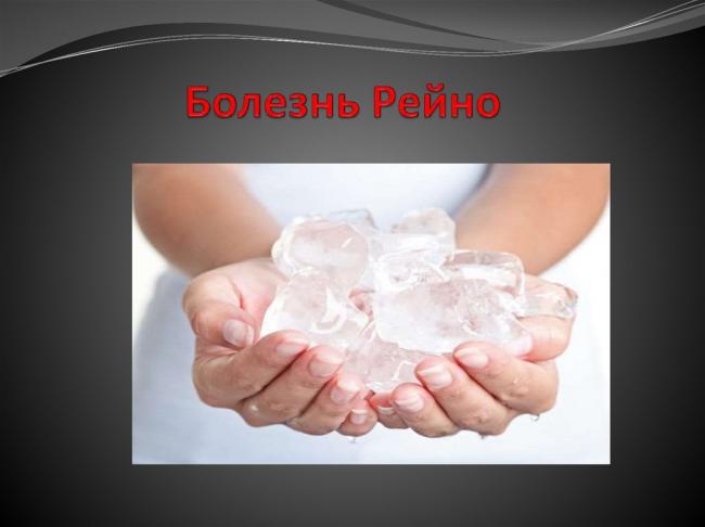 Синдром рейно причины лечение