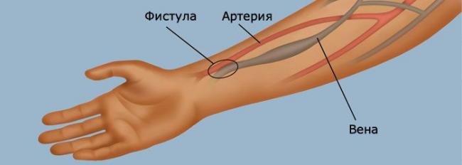 Артериовенозная фистула