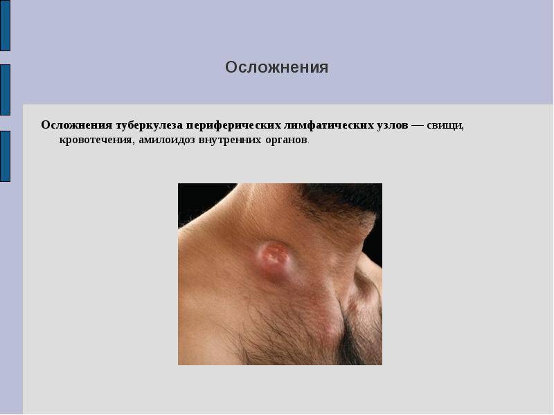 Причины появления туберкулёза лимфоузлов и эффективные методы лечения