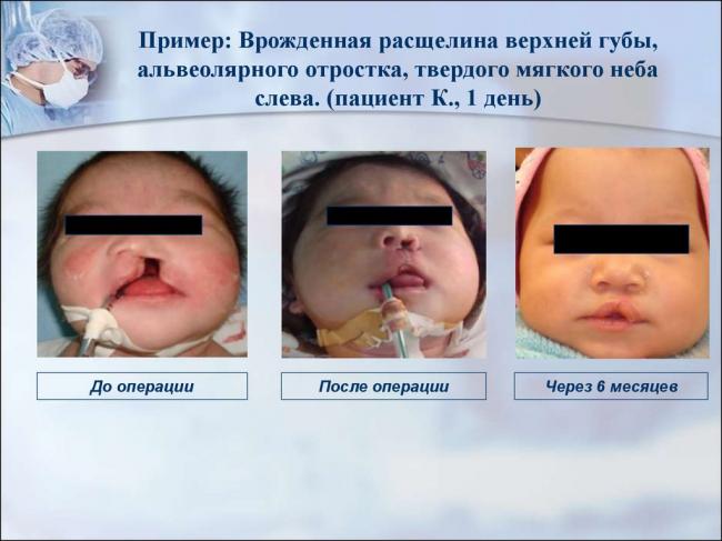 Волчья пасть у детей. фото до и после операции, причины появления, лечение