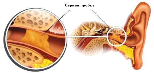 Серная пробка (церумен) - причины и механизм формирования, симптомы и лечение