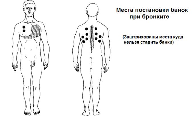 Можно ли ставить горчичники при бронхите и воспалении легких