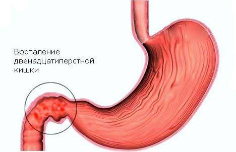 Лечение хеликобактериоза: схемы эрадикации хеликобактер пилори (применение антибиотиков, химиотерапевтических средств, препаратов висмута), народные средства, особенности питания. осложнения во время и после лечения
