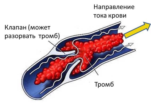 Артериовенозная фистула