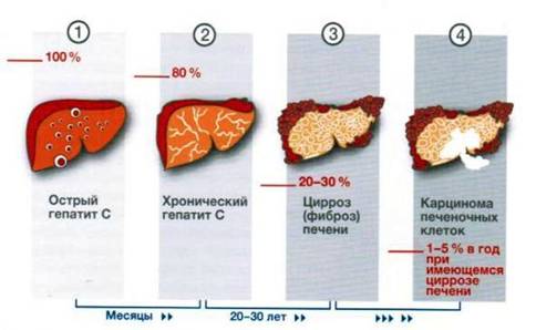 Лецитин при хроническом гепатите с