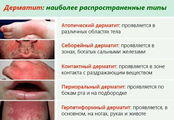 Как проявляется атопический дерматит у детей: симптомы и лечение