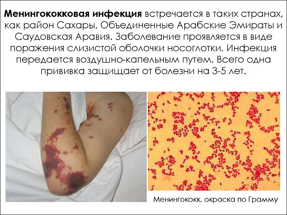 Симптомы и лечение менингококковой инфекции у детей