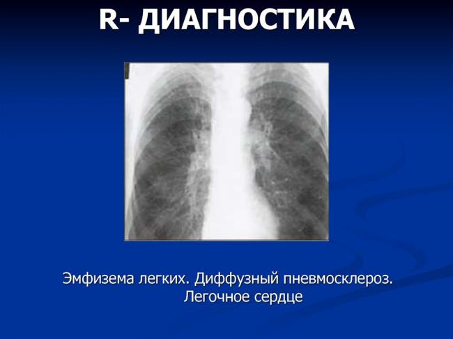 Пневмосклероз легких