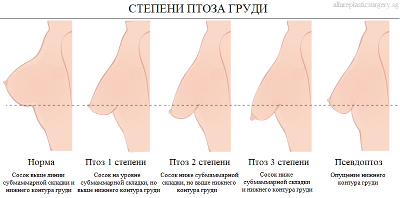 Подтяжка груди