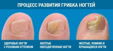 «аморолфин» — лак для лечения грибка ногтей. инструкция по применению, отзывы, цена