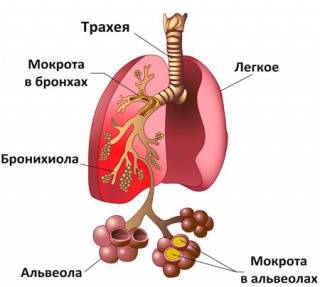 Пневмония: симптомы у взрослых, лечение и профилактика
