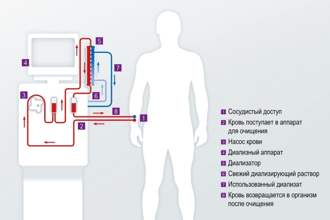 Артериовенозный свищ