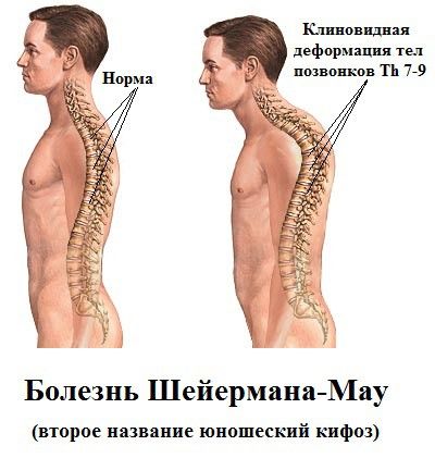 Болезнь шейермана-мау – что это такое? болезнь позвоночника шейермана-мау – лечение
