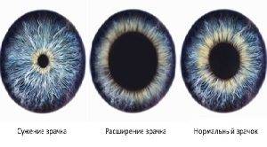 Как сузить зрачки: нафтизин