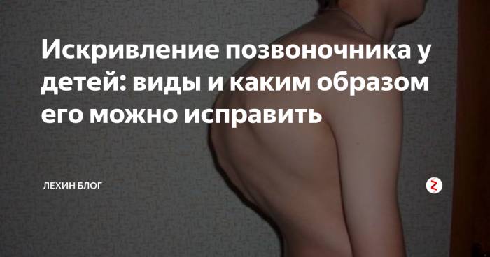 Сколиоз: диагностика, лечение, профилактика