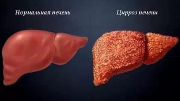 Как убрать желтизну глаз белков народными средствами