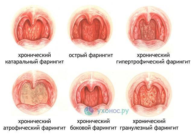 Атрофический фарингит: симптомы и современное лечение