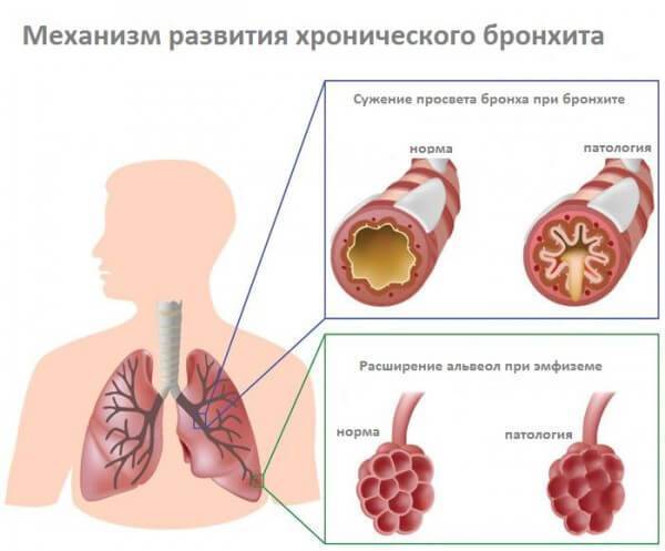 Симптомы и лечение бронхита у взрослых