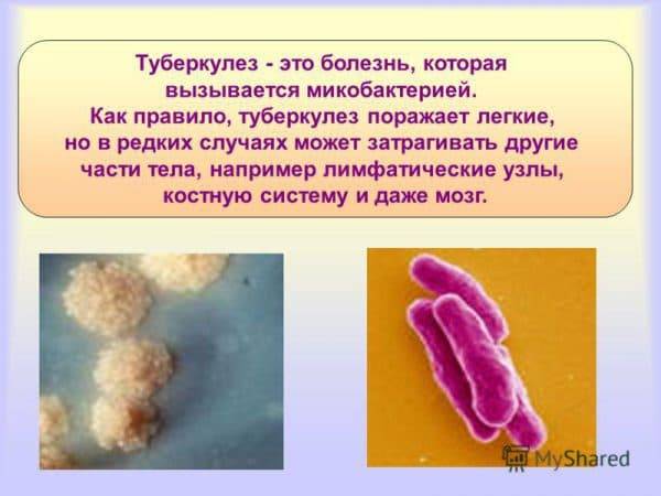 Туберкулез: пути передачи, симптомы, профилактика
