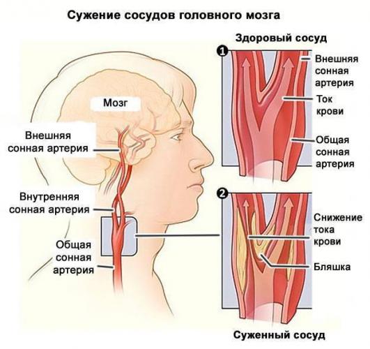 Стеноз сосудов в шейном отделе позвоночника
