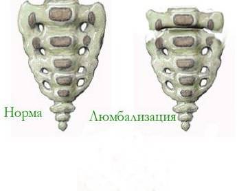Позвоночник шестой поясничный позвонок