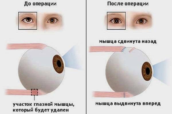 Косоглазие у новорожденных: 6 факторов косоглазия у младенцев, истинное косоглазие
