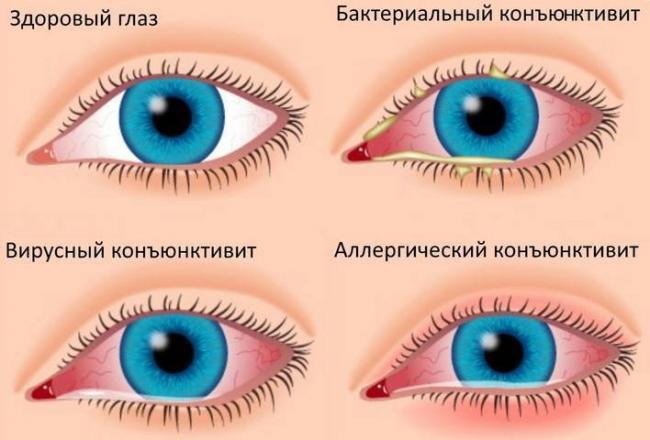 Покраснение глаз