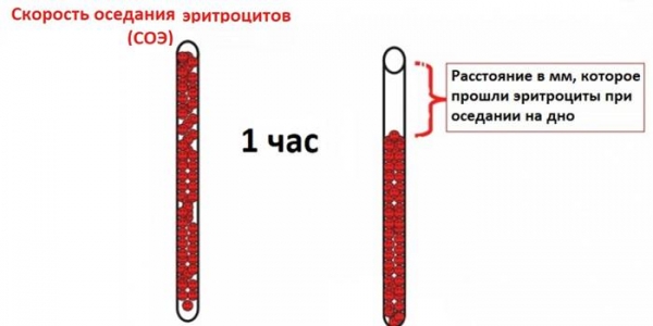 Скорость оседания эритроцитов (соэ) у женщин и мужчин