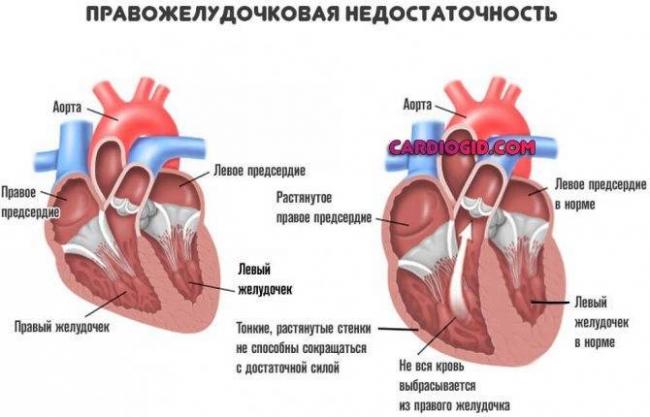 Сердечный кашель, причины, симптомы и лечение
