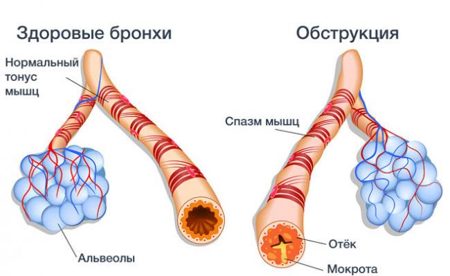 Кашля нет а мокроты отхаркиваются причины