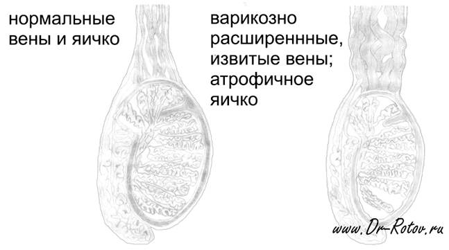 Варикоцеле – причины, симптомы, диагностика. лечение патологии: показания к операции, подготовка, виды операции, после операции. возможные осложнения после операции: боли, отек, швы. прогноз после варикоцеле. :: polismed.com