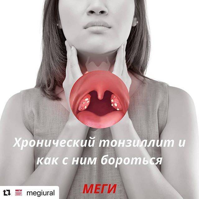 Как и чем можно быстро вылечить тонзиллит навсегда?