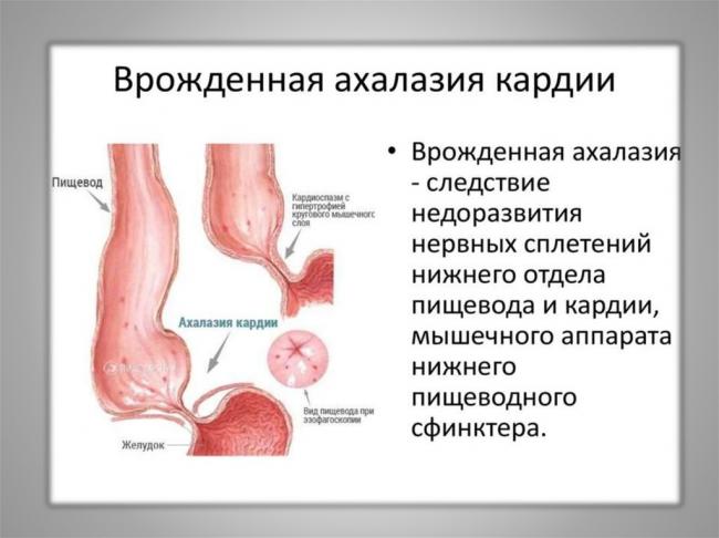 Ахалазия пищевода - симптомы болезни, профилактика и лечение ахалазии пищевода, причины заболевания и его диагностика на eurolab