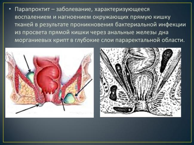 Парапроктит