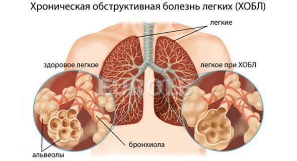 Курение и пневмония: вред привычки и последствия при заболевании
