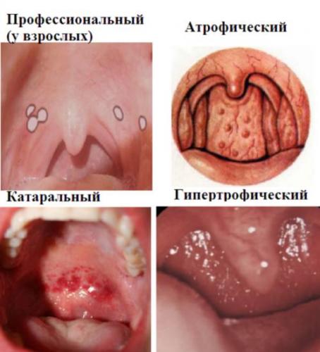 Ларингит у взрослых: симптомы острого ларингита, лечение. как и чем лечить ларингит у взрослых