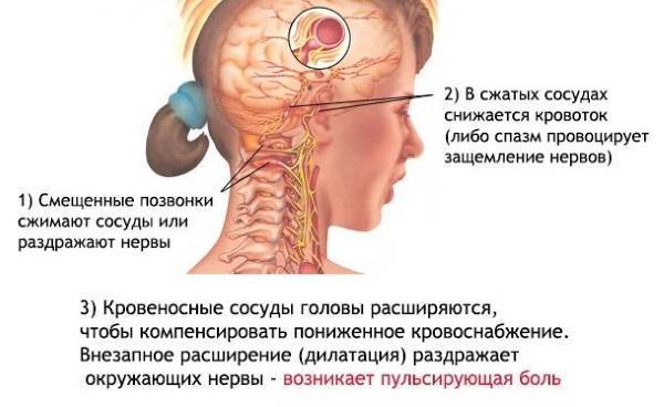 Где болит голова при шейном остеохондрозе фото