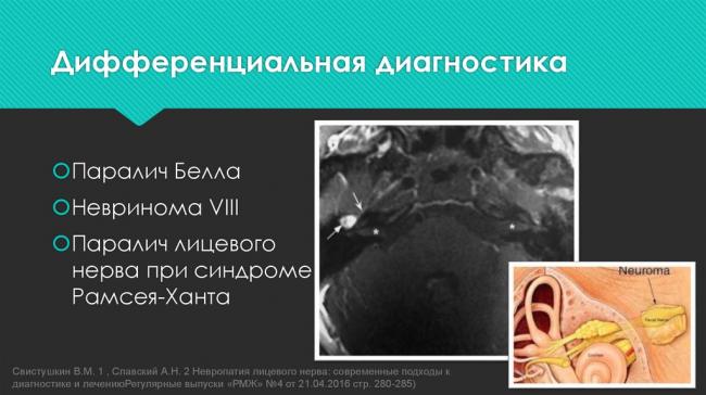 Неврит лицевого нерва – чем опасен и как лечить паралич белла?